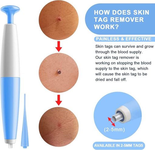 Skin Tag Removal Kit Mole Wart Remover